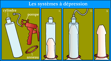 pompes-à-pénis-fonctionnement La pompe à pénis provoque l'arrivée du sang dans le pénis en vidant l'air à l'intérieur du cylindre.